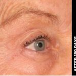 Ultherapy Before & After Patient #1553